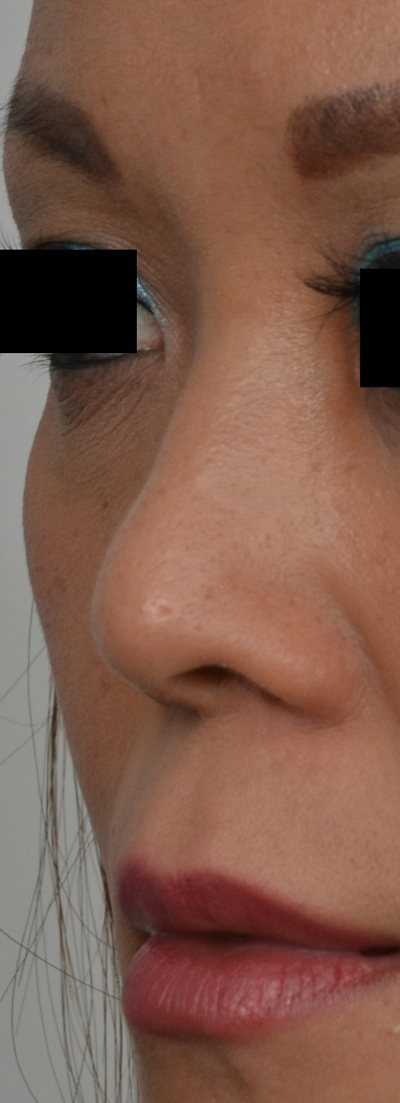 Rhinoplasty