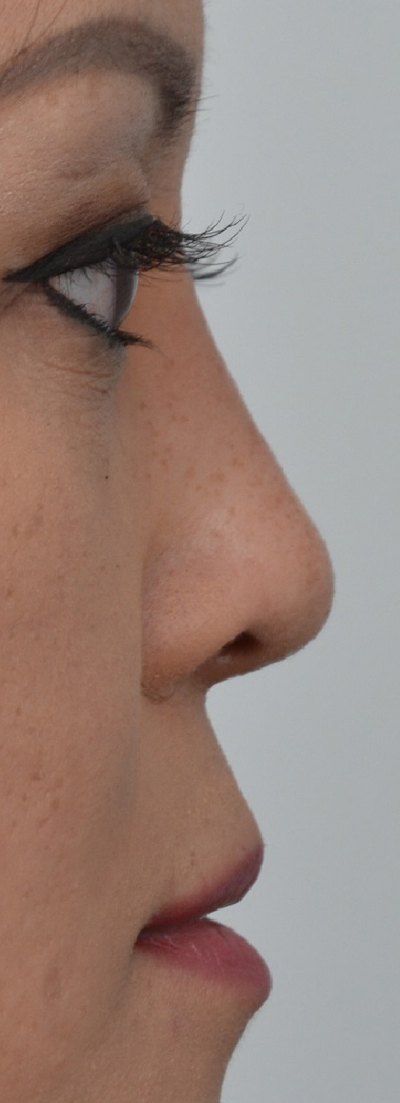 Rhinoplasty