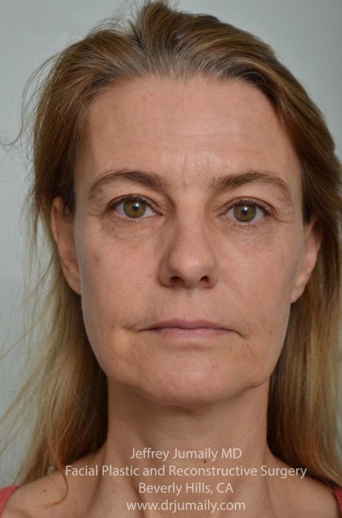 Fillers and Non-Surgical