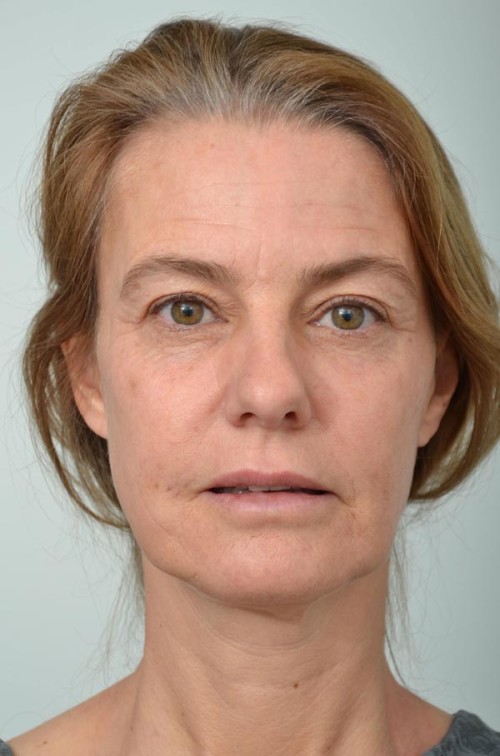 Fillers and Non-Surgical