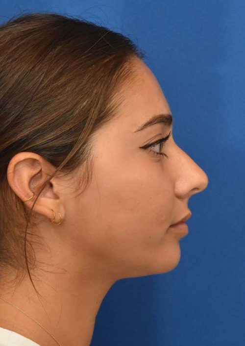 Rhinoplasty