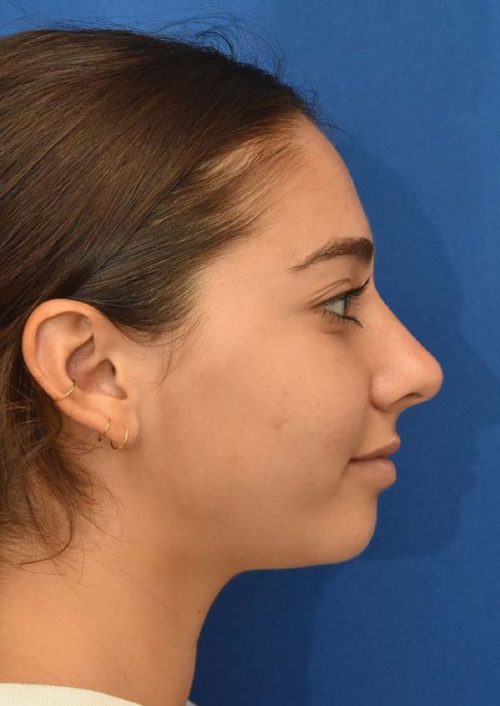 Rhinoplasty