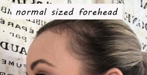 Forehead Reduction/Hairline Lowering
