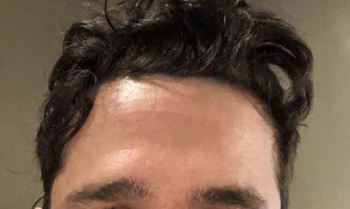 Forehead Reduction/Hairline Lowering