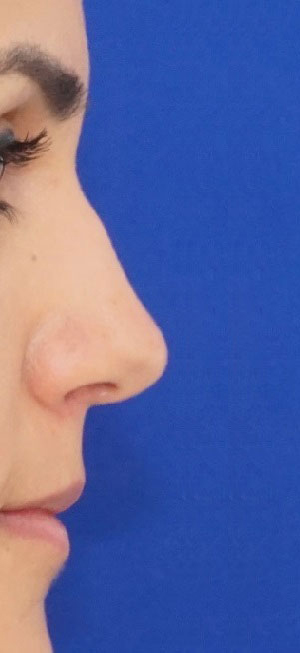 Rhinoplasty