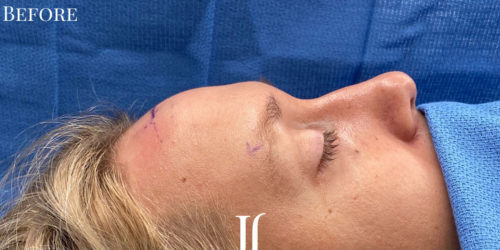 Complete Upperface Transformation