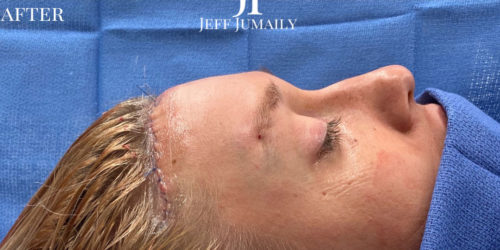 Complete Upperface Transformation