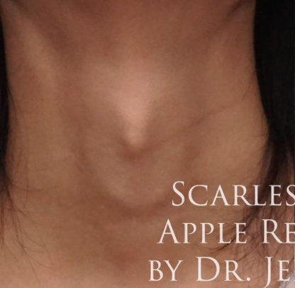 Thyroid Cartilage Reduction (Adam's Apple Reduction) Before & After Results
