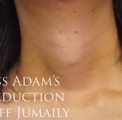 Thyroid Cartilage Reduction (Adam's Apple Reduction) Before & After Results