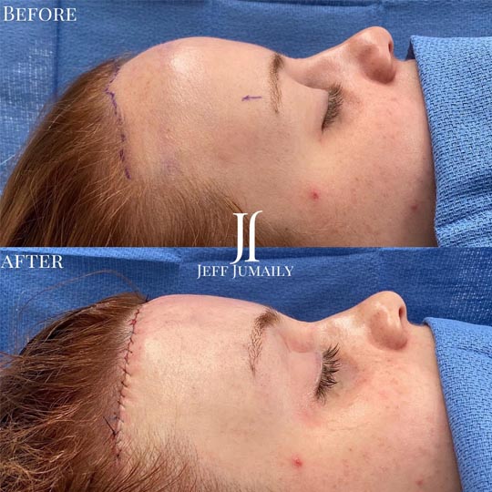 Patient Before and After Procedure
